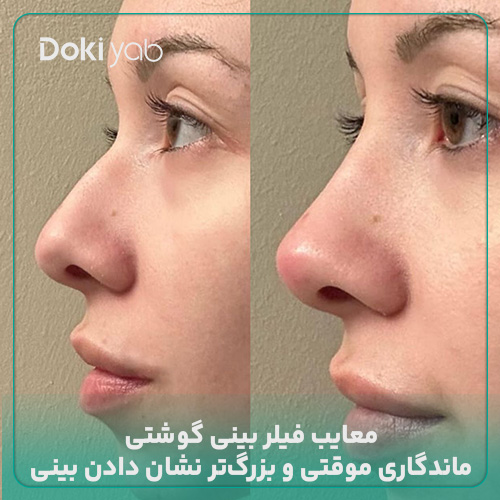 عکس فیلر بینی گوشتی؛ بررسی محدودیت‌ها در مجله دکی یاب