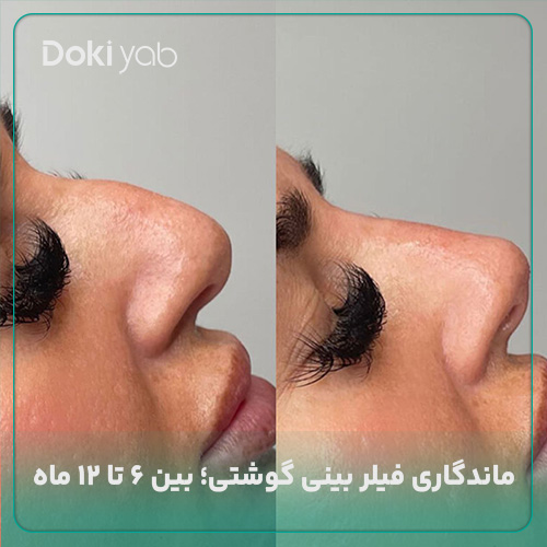 عکس فیلر بینی گوشتی در سایت دکی یاب