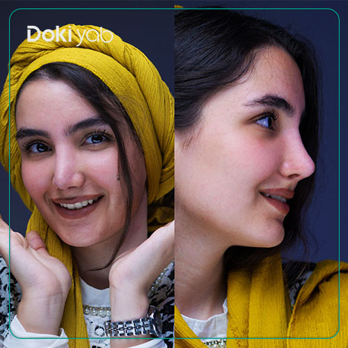 نمونه عمل بینی با دکی یاب؛ مقایسه فیلر بینی گوشتی و جراحی