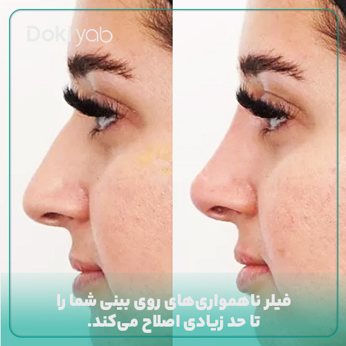 اصلاح ناهمواری و قوز با تزریق فیلر بینی استخوانی