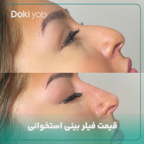 بررسی قیمت فیلر بینی استخوانی در مجله دکی یاب