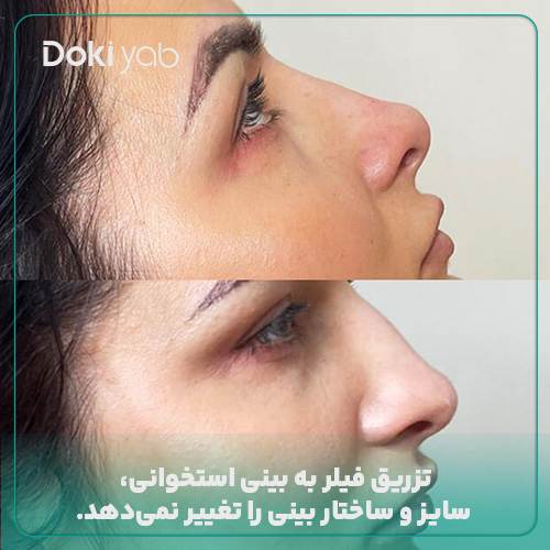 تزریق فیلر بینی استخوانی، تاثیری روی استخوان آن ندارد