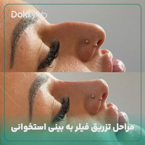 مراحل تزریق فیلر بینی استخوانی
