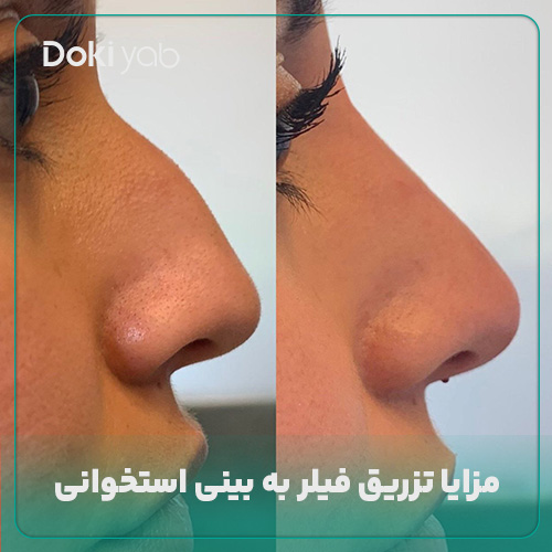 عکس فیلر بینی استخوانی در مجله دکی یاب