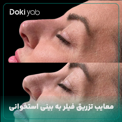 عکس فیلر بینی استخوانی؛  سایت دکی یاب