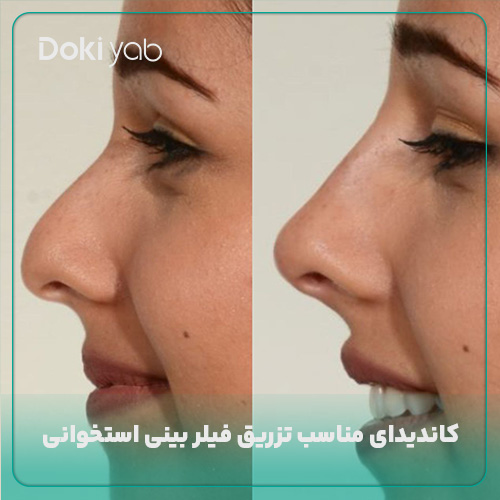 بررسی کاندیدای مناسب تزریق ژل بینی؛ عکس فیلر بینی استخوانی