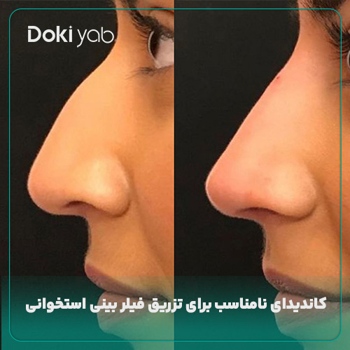 بررسی کسانی‌که نباید فیلر تزریق کنند در مجله دکی یاب