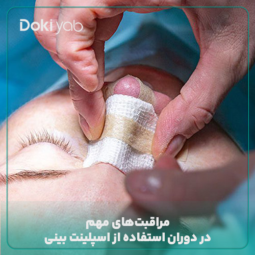 مراقبت از اسپلینت بینی؛ مجله دکی یاب
