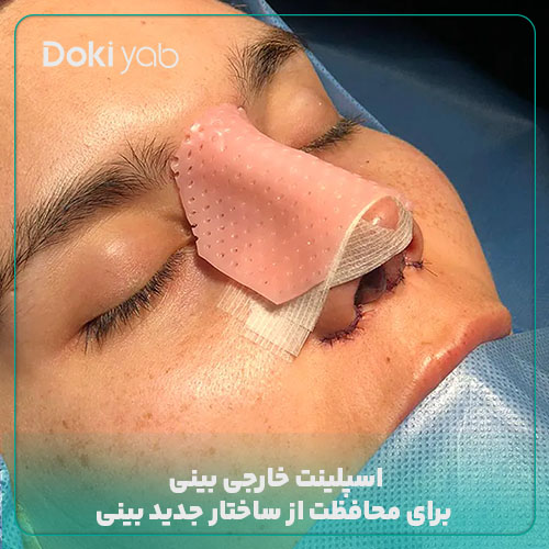 اسپلینت خارجی بینی برای محافطت از ساختار بینی؛ دکی یاب