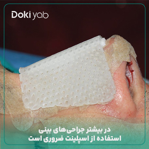 ضرورت استفاده از اسپلینت بینی بعد از عمل؛ مجله دکی یاب
