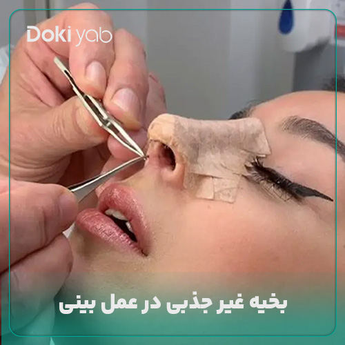 بخیه غیر جذبی در عمل بینی 