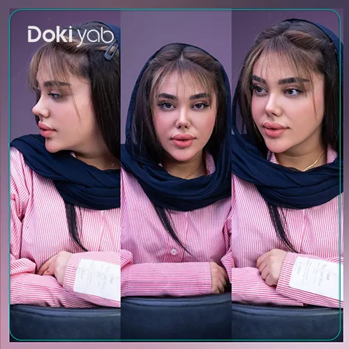 عکس جراحی بینی نیمه فانتزی در شیراز با مشاوره مجموعه دکی یاب