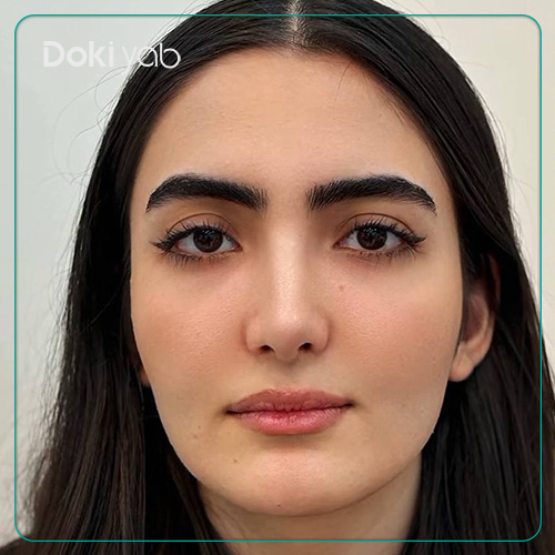 نمونه عمل بینی دکتر حسین کرم نژاد با مشاوره دکی یاب در شیراز