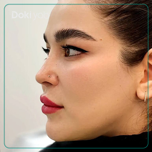 نمونه جراحی بینی دکتر حسین کرم نژاد در شیراز با مشاوره دکی یاب