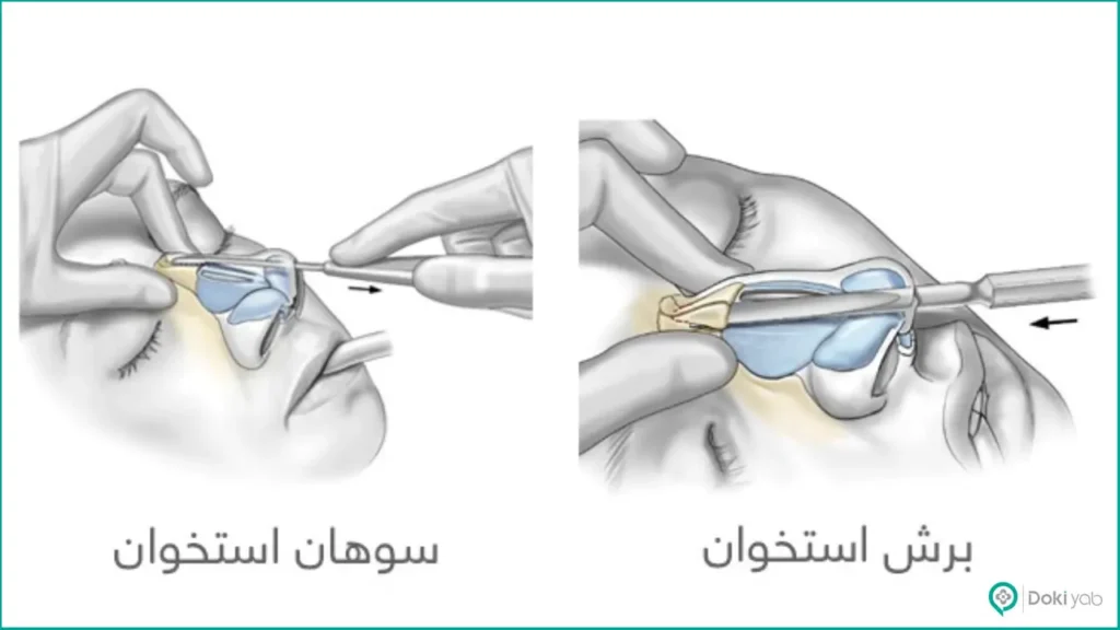 جراحی بینی به روش پرزرویشن چیست؟