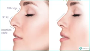 عمل نوک بینی گوشتی: بهترین جراحان + تصاویر قبل و بعد