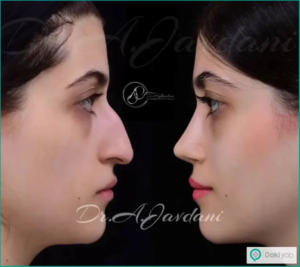 نمونه جراحی بینی دکتر علی جاودانی بهترین جراح بینی در تهران