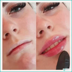 بهترین زمان برای ترمیم ژل لب + هزینه ترمیم ژل لب سال 1404