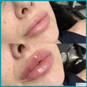 ژل لب مدل هالیوودی چیست؟ عکس لب هالیوودی + هزینه و مراقبت‌ها