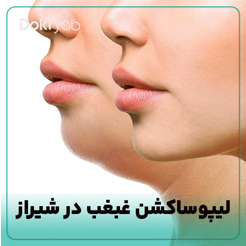 بررسی لیپوساکشن غبغب در شیراز در دکی یاب