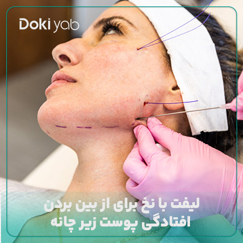 رفع افتادگی چانه و غبغب با لیفت با نخ در شیراز