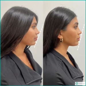 برای زاویه سازی صورت ژل بهتر است یا چربی؟ مقایسه کامل