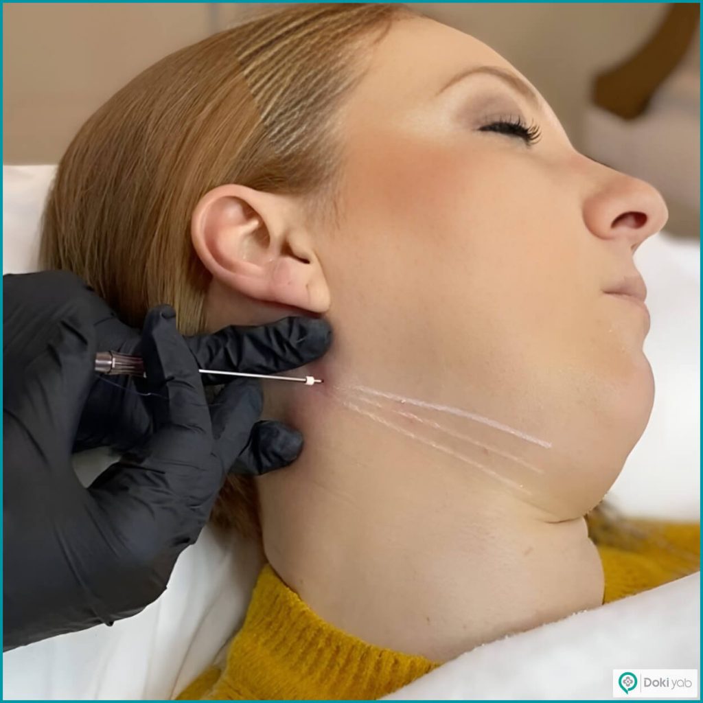 تاثیر کیفیت و ماندگاری نخ بر هزینه لیفتینگ صورت با نخ در شیراز