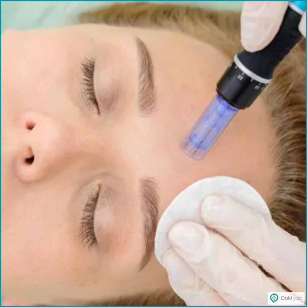 میکرونیدلینگ BB Glow در شیراز