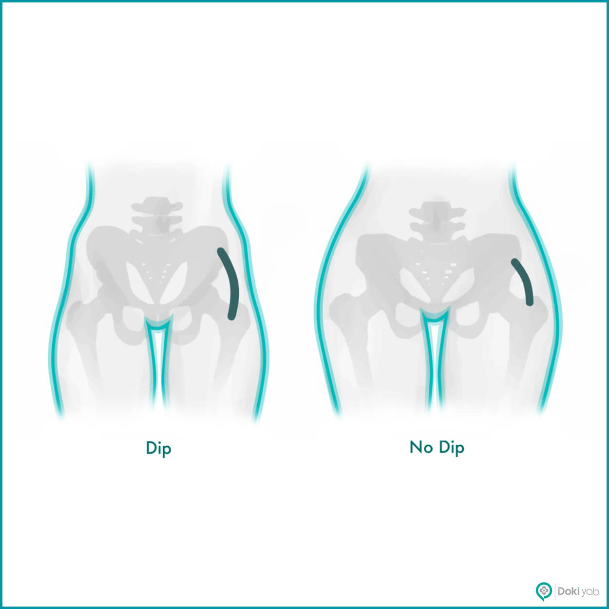 معرفی بهترین دکتر تزریق ژل به هیپ دیپ در شیراز؛ مجموعه دکی یاب