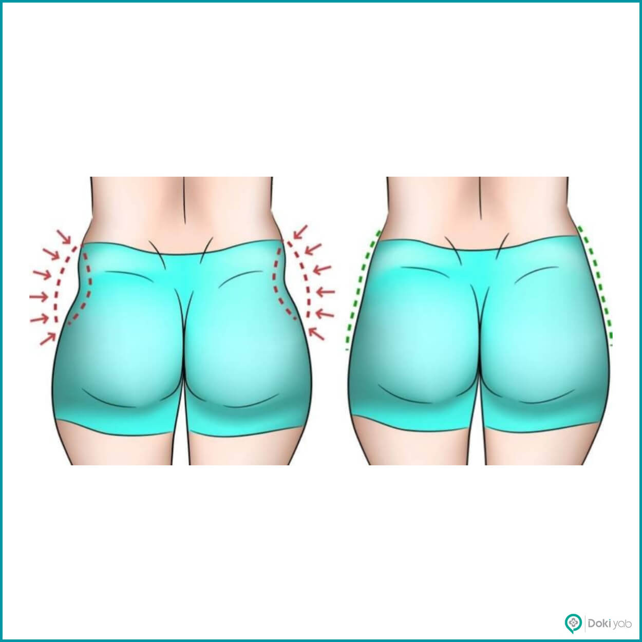 تزریق ژل به هیپ دیپ در شیراز در زی کلینیک