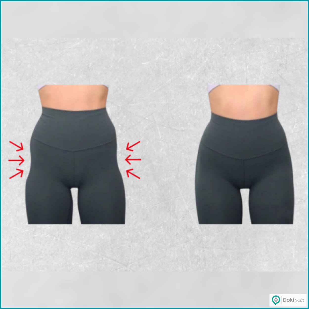 هزینه تزریق ژل به هیپ دیپ در شیراز؛ مجموعه دکی یاب