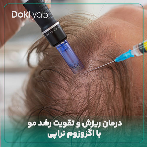 اگزوزوم تراپی برای درمان ریزش مو