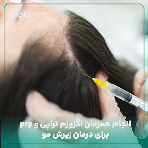 درمان ریزش مو با انجام همزمان اگزوزم تراپی و prp