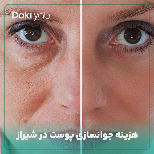 بررسی هزینه جوانسازی پوست در شیراز در دکی یاب