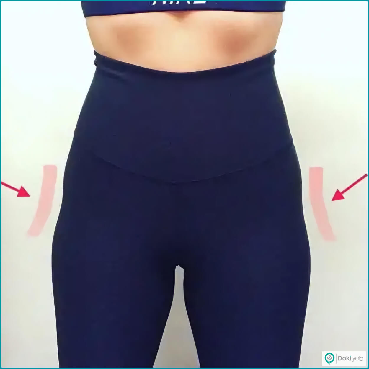 تزریق ژل به هیپ دیپ در شیراز برای برطرف کردن فرورفتگی‌هایی کناره‌های لگن