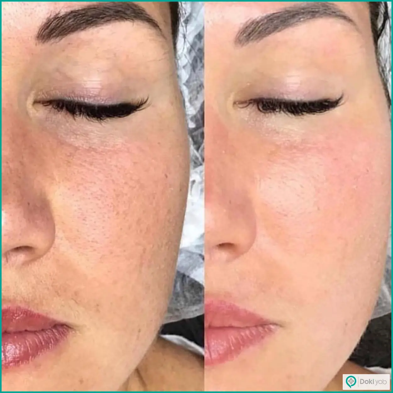 بررسی هزینه تزریق مزوژل به صورت در شیراز؛ عکس نمونه قبل و بعد تزریق مزوژل