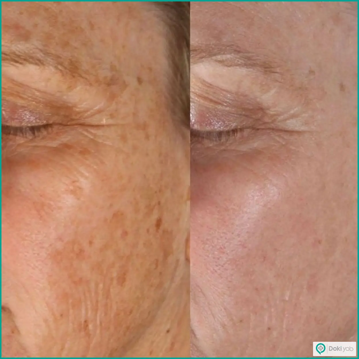 عکس قبل و بعد مزوژل صورت برای بهتر شدن بافت پوست زیر چشم