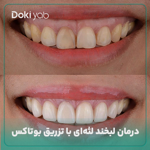 بررسی درمان لبخند لثه ای با تزریق بوتاکس در شیراز در دکی یاب