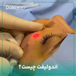 بررسی این‌که اندولیفت چیست در دکی یاب