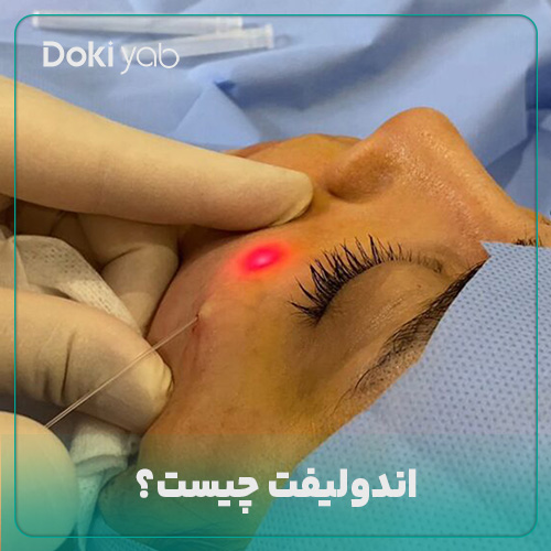 بررسی اینکه اندولیفت چیست در دکی یاب