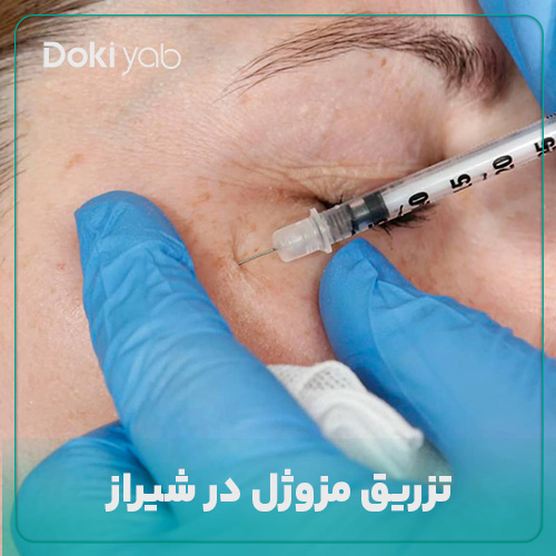 همه چیز درباره تزریق مزوژل در شیراز