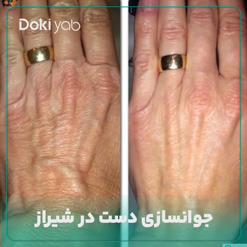 همه چیز درباره جوانسازی دست در شیراز در دکی یاب