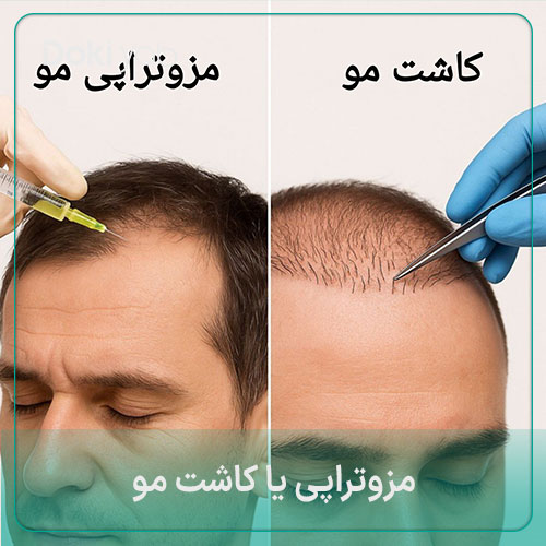 مزوتراپی یا کاشت مو؟ ۹ تفاوت کاشت مو و مزوتراپی