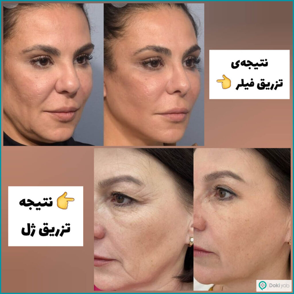 فرق ژل و فیلر