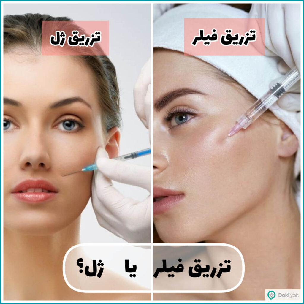 ژل بهتره یا فیلر؟
