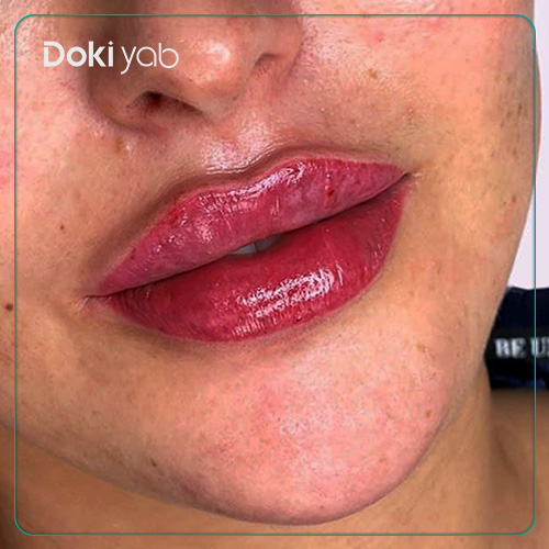 تصویر تزریق ژل لب روسی در مجله دکی یاب