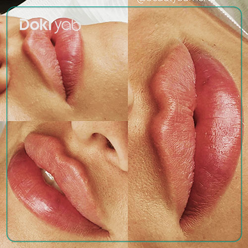 تصویر نمونه کار تزریق زل لب روسی در دکی یاب