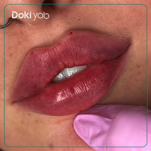 عکس ژل لب روسی در مجله دکی یاب