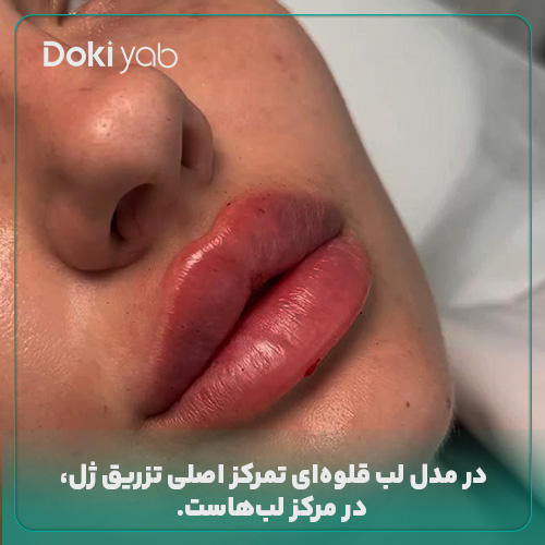 تمرکز در تزریق فیلر در مرکز لب در ژل لب قلوهای