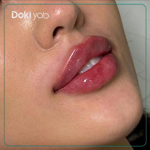 معرفی پزشکان خوب تزریق فیلر لب قلوهای در شیراز در دکی یاب